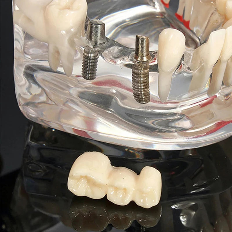 A close-up of a dental implant system displayed on a transparent jaw model, with two metallic implant posts and several natural-looking teeth visible. A separate tooth prosthesis is placed in front on a glossy black surface.