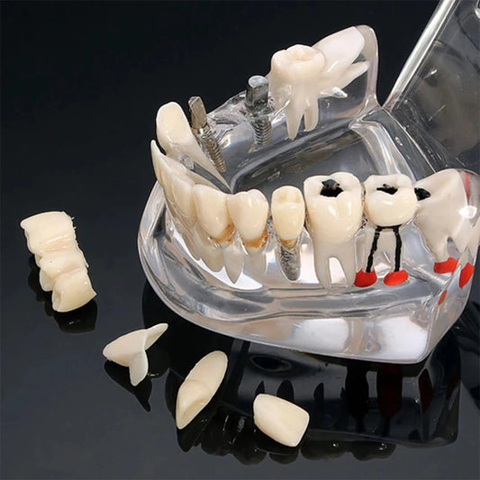 A dental implant model display on a clear acrylic jawform, showing natural-looking tooth replicas, several implants with screws, and a few loose tooth fragments on a glossy black background.