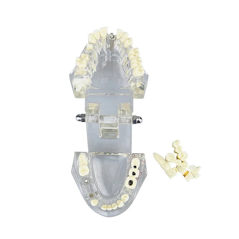 A dental model showing an upper and lower jaw with multiple ivory-colored teeth, alongside a small pile of loose teeth pieces on a plain white background.