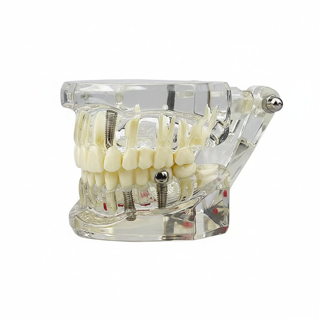 A clear acrylic dental model showing a full set of teeth and implants, Dental Typodont Teeth Model for Medical education

