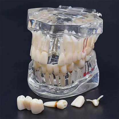 A transparent dental jaw model showing a set of white teeth, with several individual tooth pieces arranged in front on a dark background.